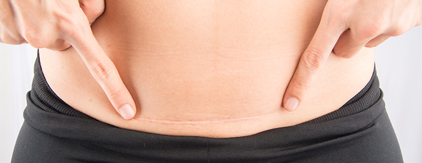 Jak pielęgnować bliznę po cesarce￼